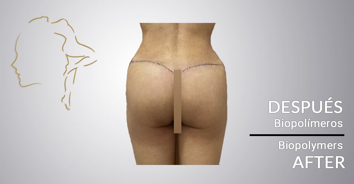1 Case of success after biopolymer removal on the buttocks