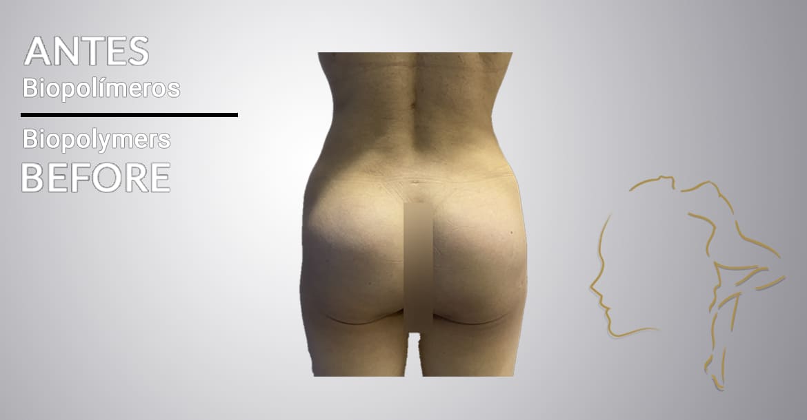Successful case of biopolymer removal on buttocks