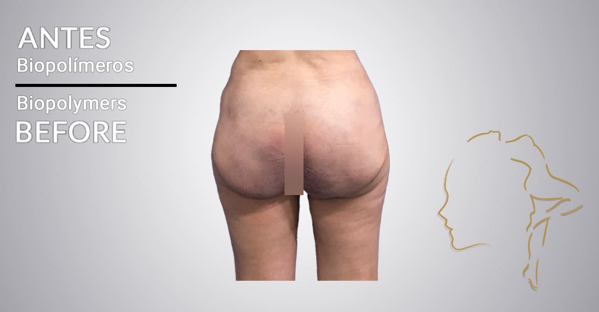 case of success before buttock surgery with biopolymers