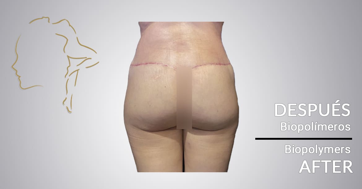 Successful case of patients after biopolymer removal in buttocks