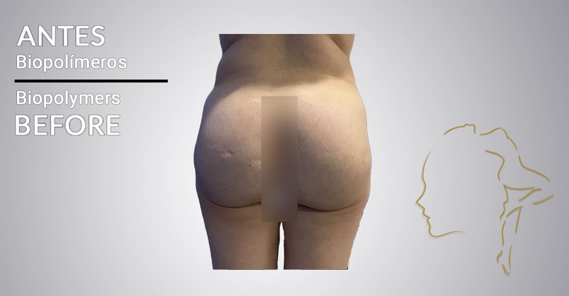Successful case of patients before biopolymer removal in buttocks