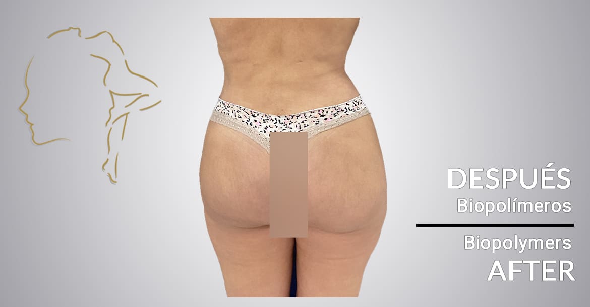 Successful case after biopolymer removal in the buttocks