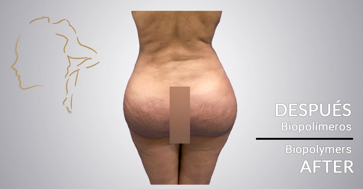 Successful surgery after biopolymer removal in buttocks