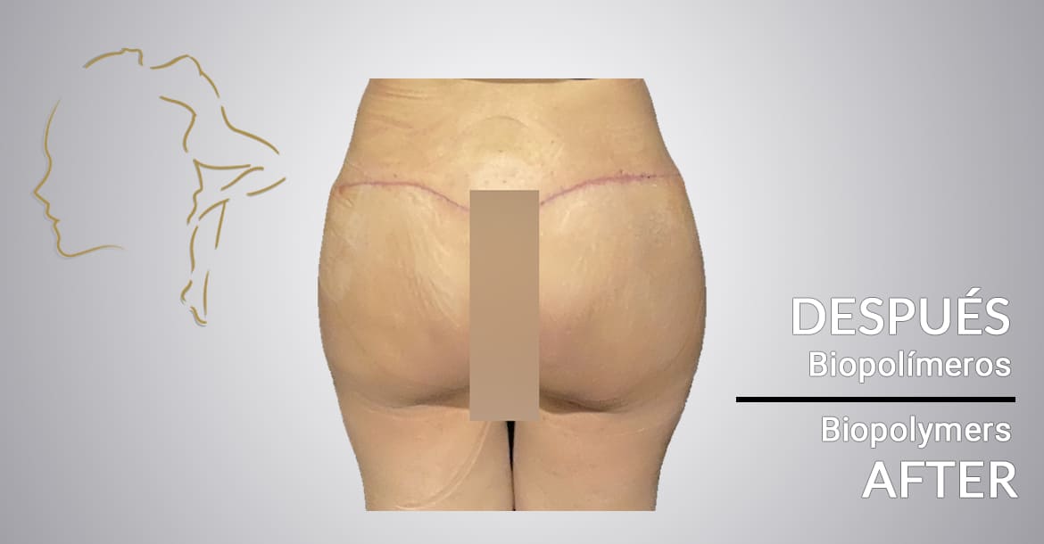 Patient testimonials after buttocks biopolymer removal