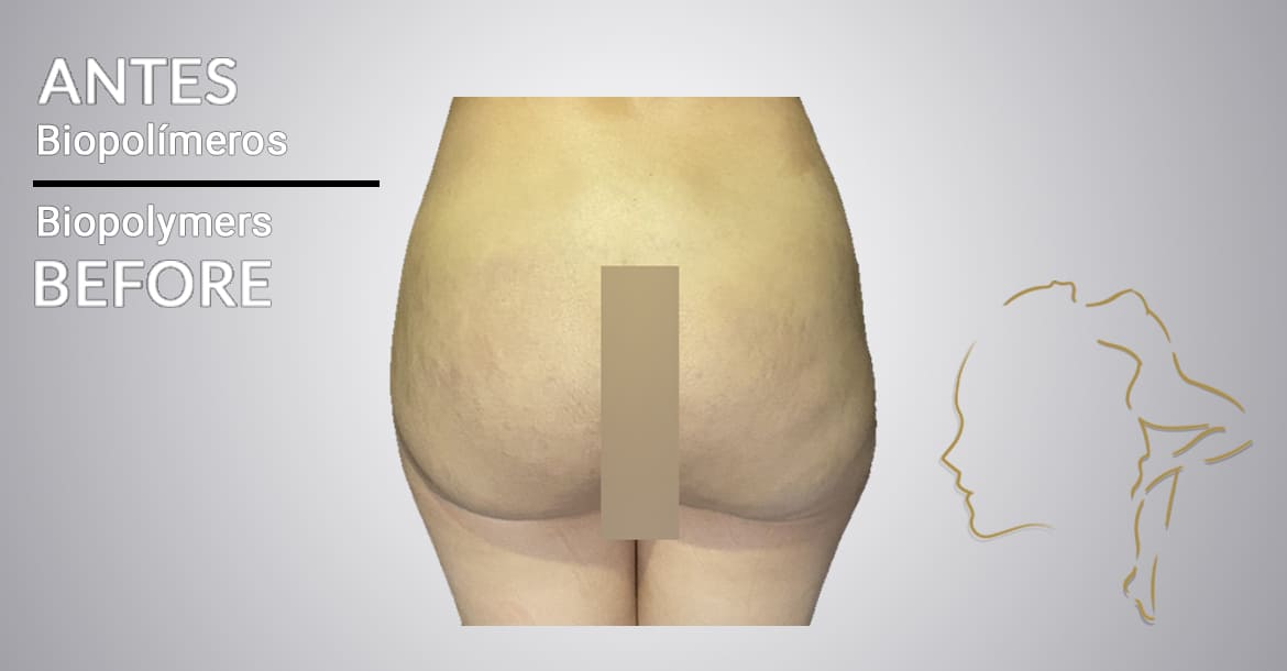 Patient testimonials before buttocks biopolymer removal